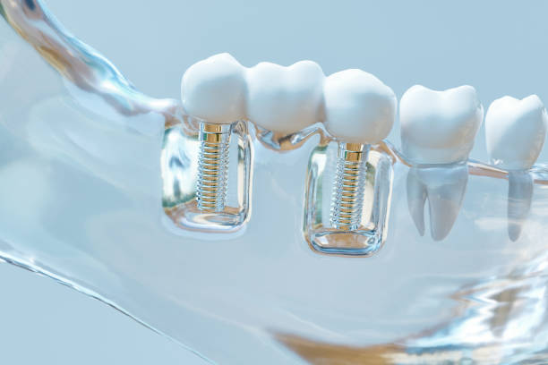 Tooth human implant -- 3D Rendering